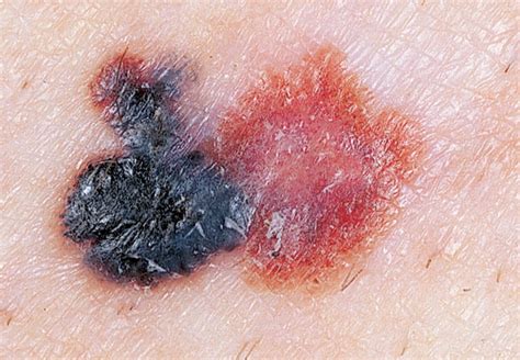 dermnet melanoma